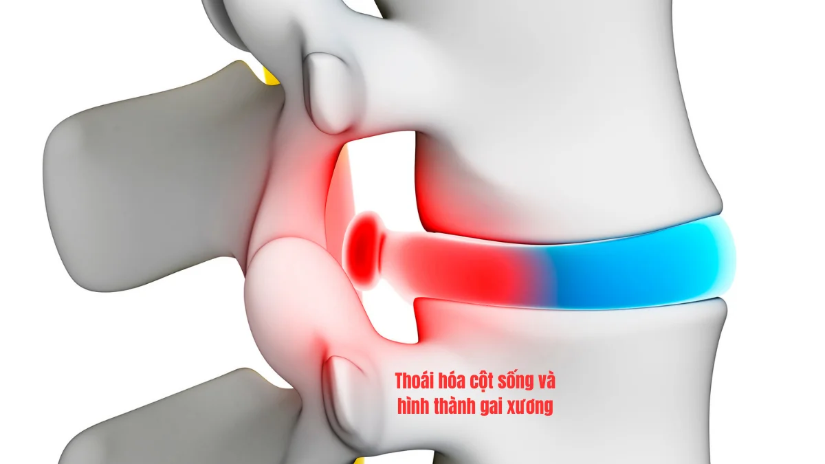 Thoát vị đĩa đệm